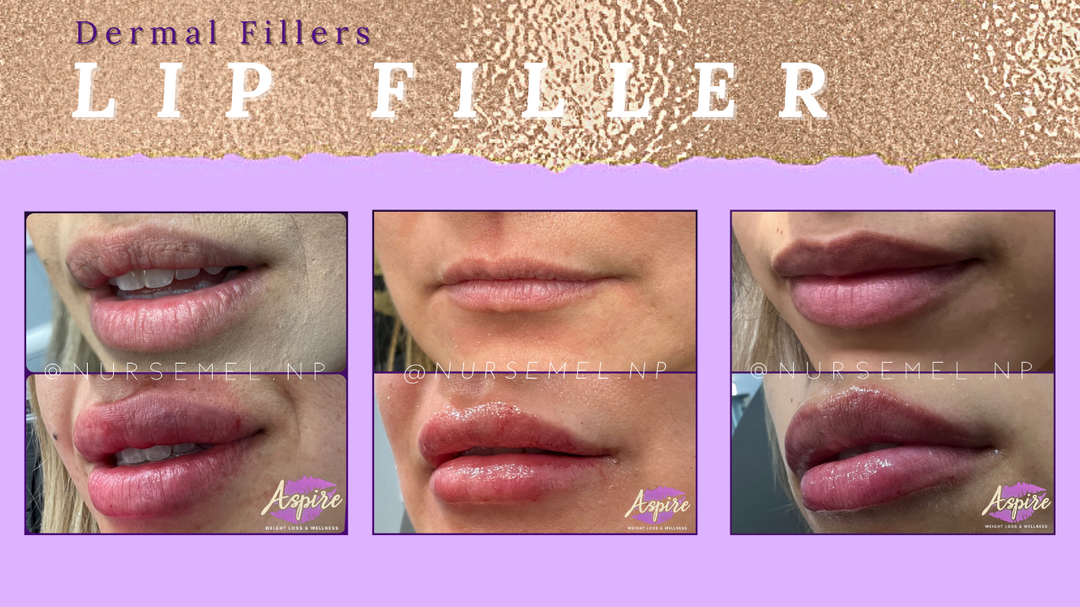 VIP Lip Filler Membership