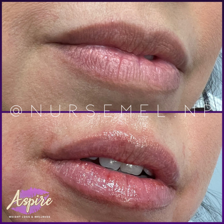 VIP Lip Filler Membership