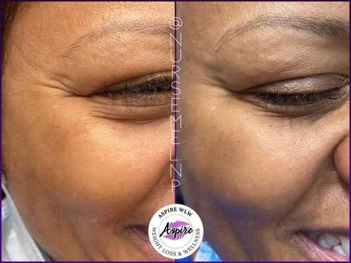 VIP Botox Membership