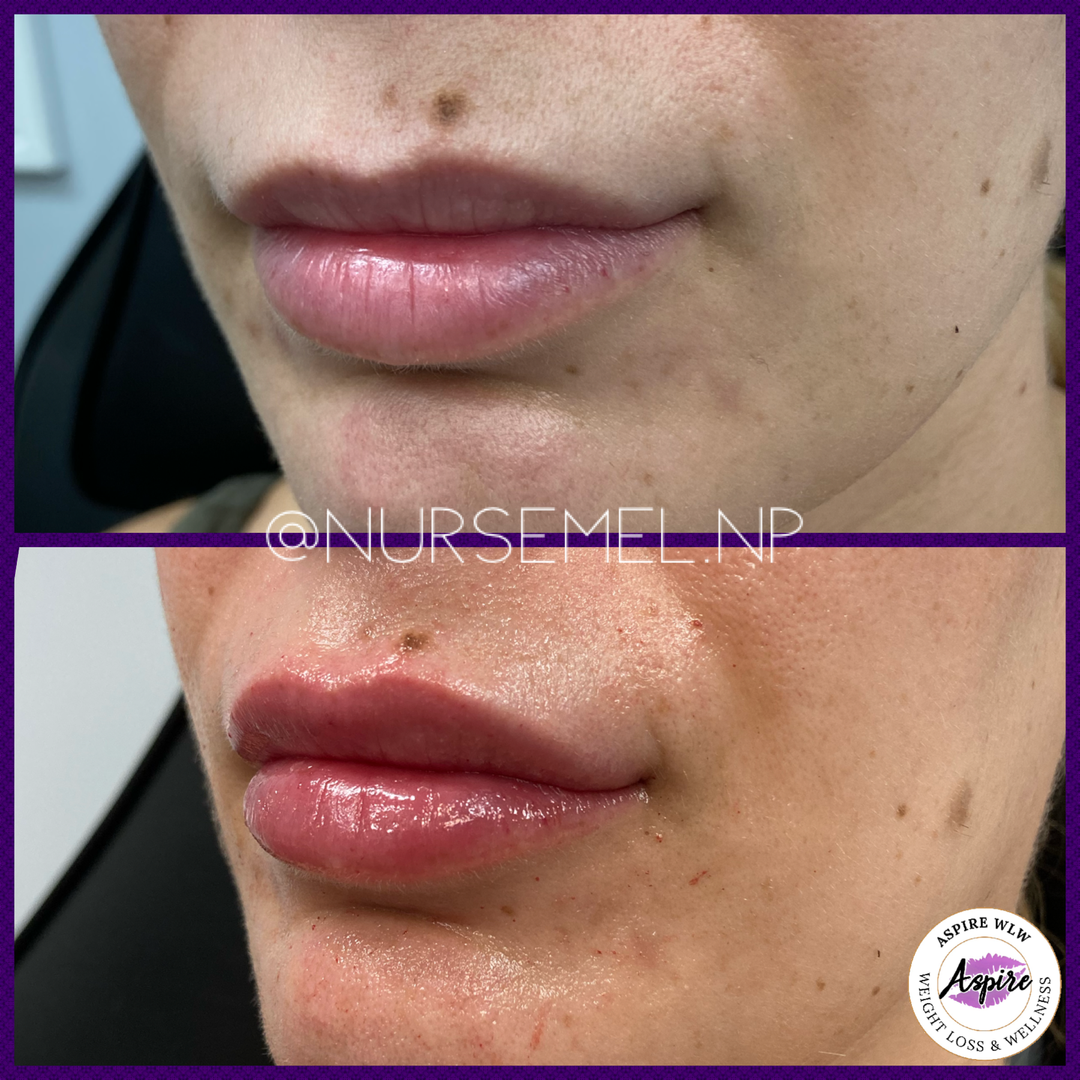 VIP Lip Filler Membership