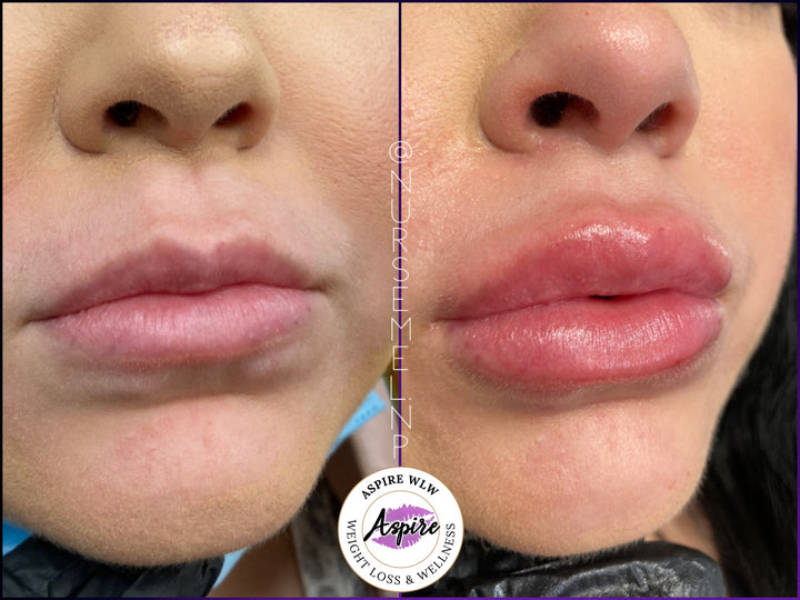VIP Lip Filler Membership