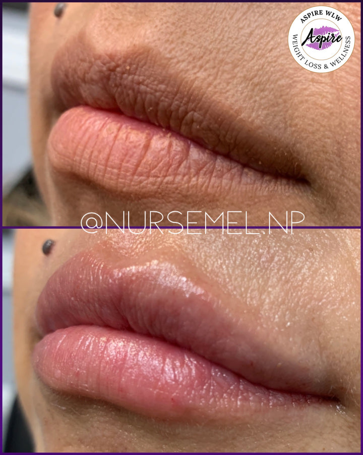 VIP Lip Filler Membership