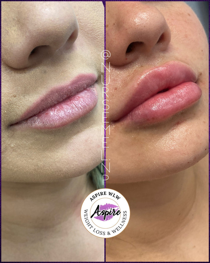 VIP Lip Filler Membership