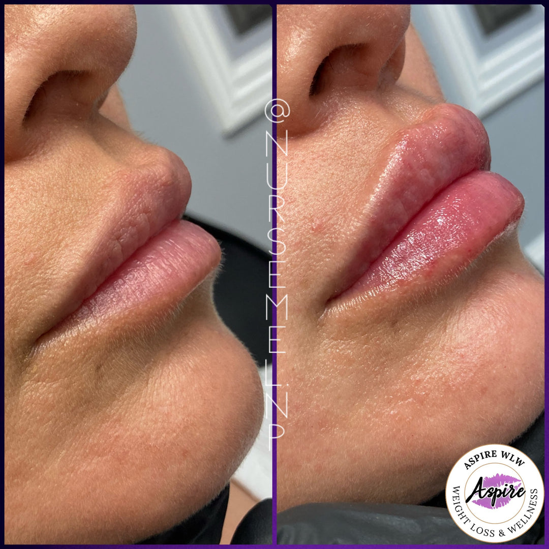 VIP Lip Filler Membership