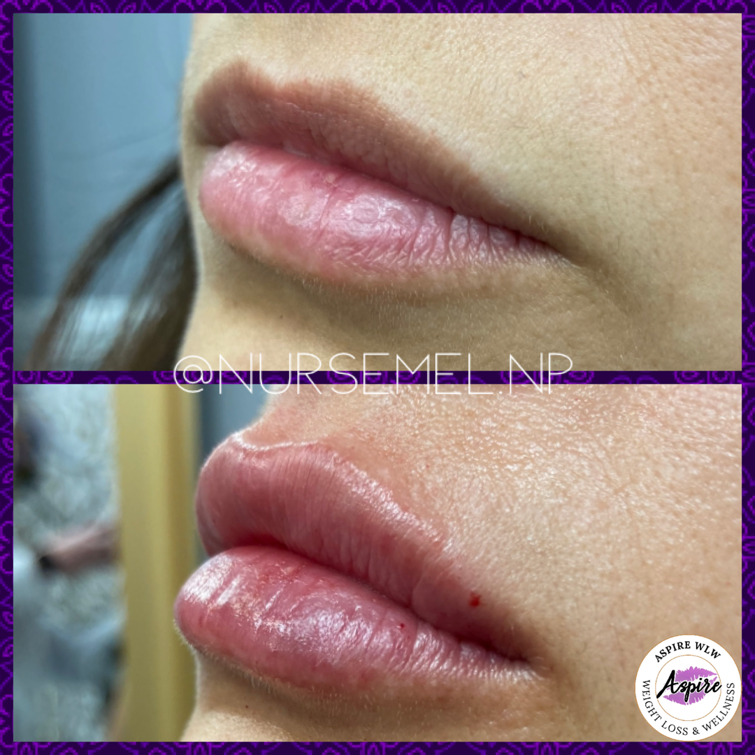 VIP Lip Filler Membership