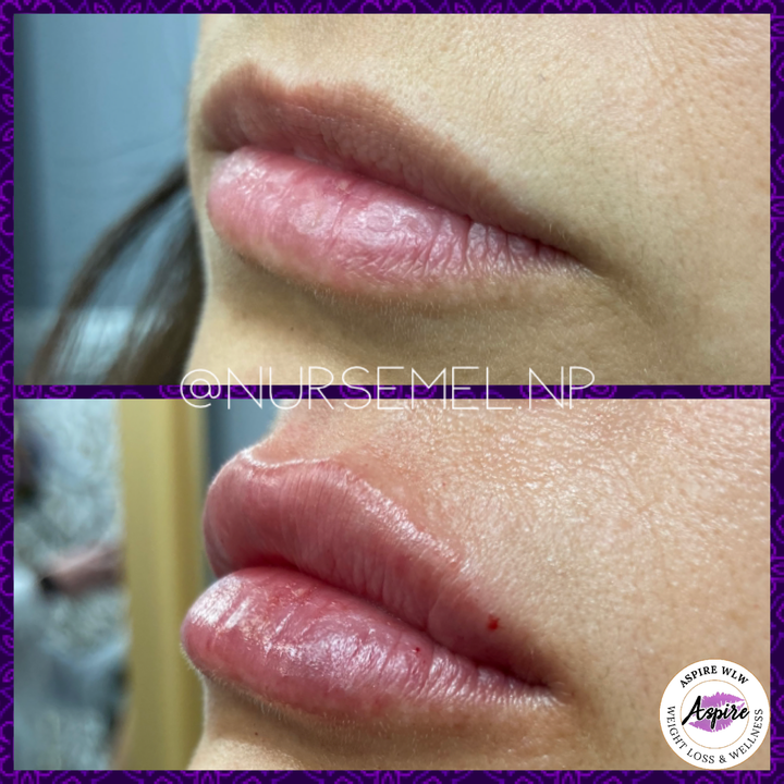 VIP Lip Filler Membership