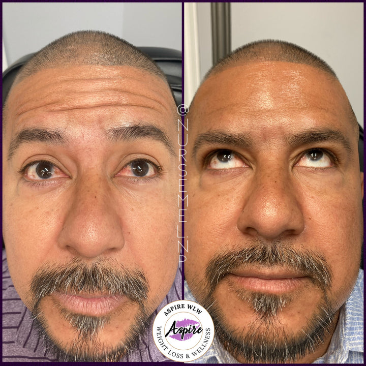 VIP Botox Membership