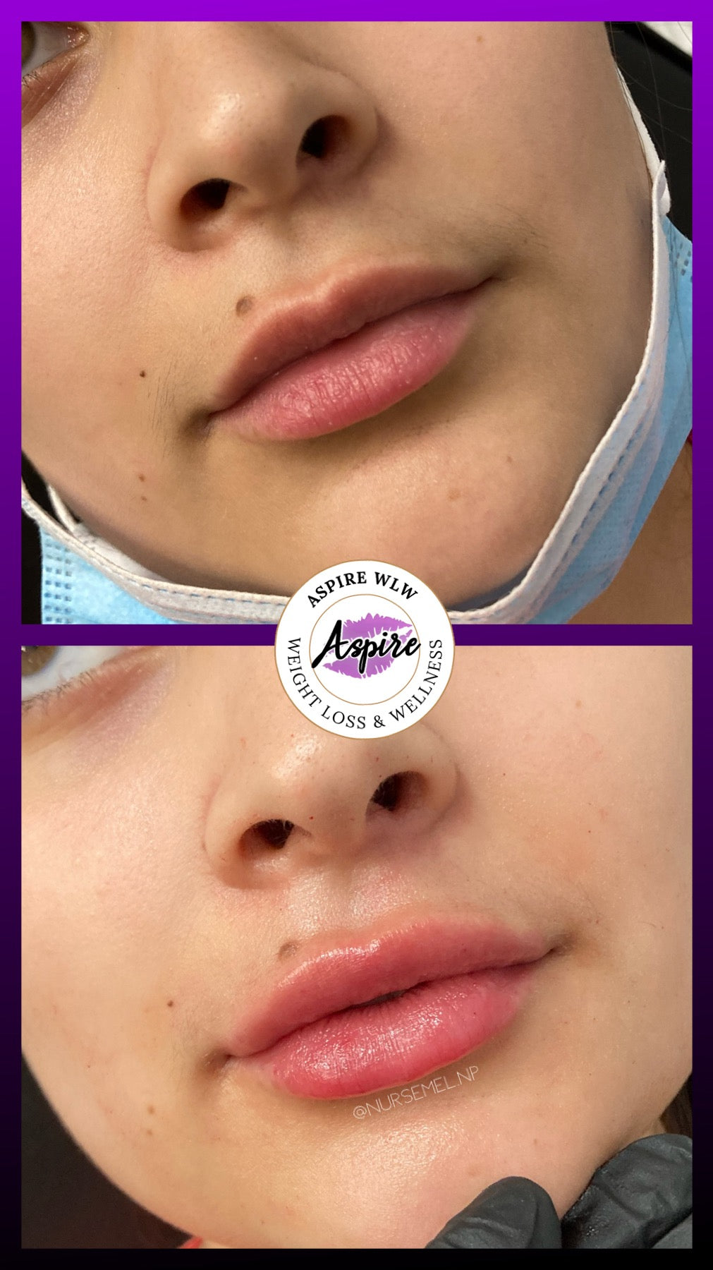 VIP Lip Filler Membership
