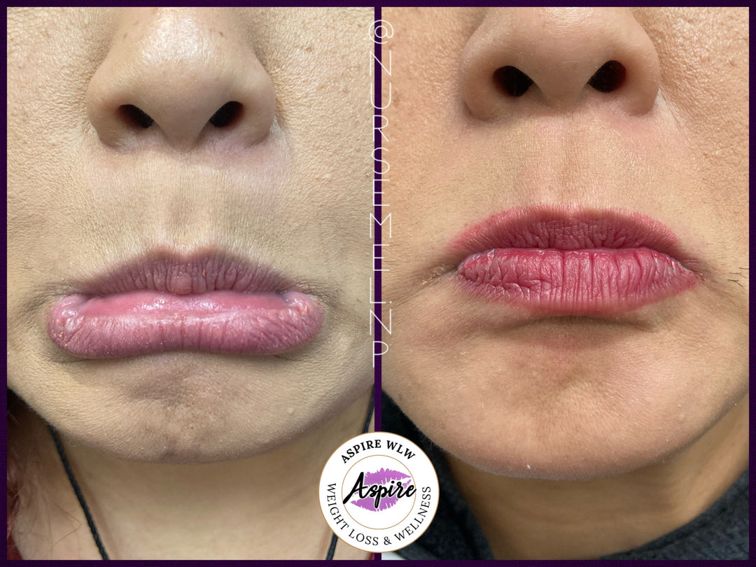 VIP Botox Membership