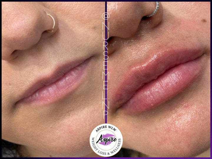 VIP Lip Filler Membership