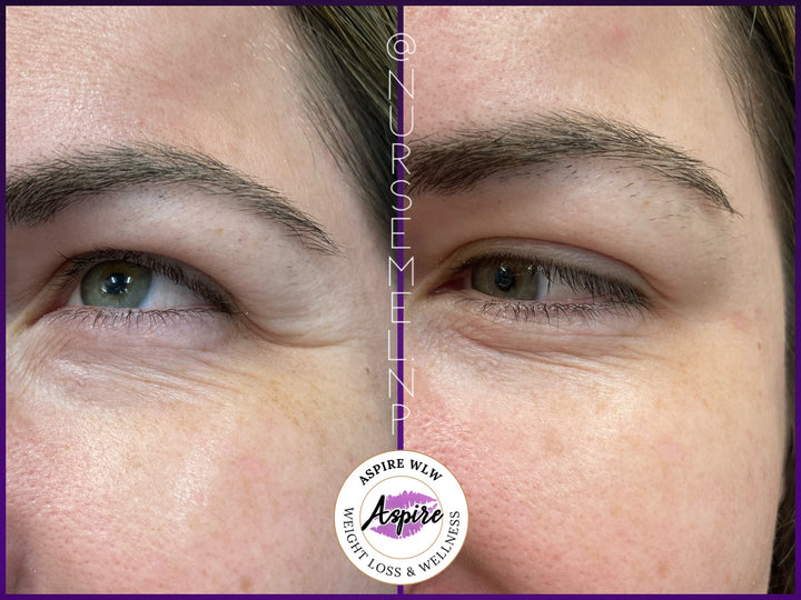 VIP Botox Membership